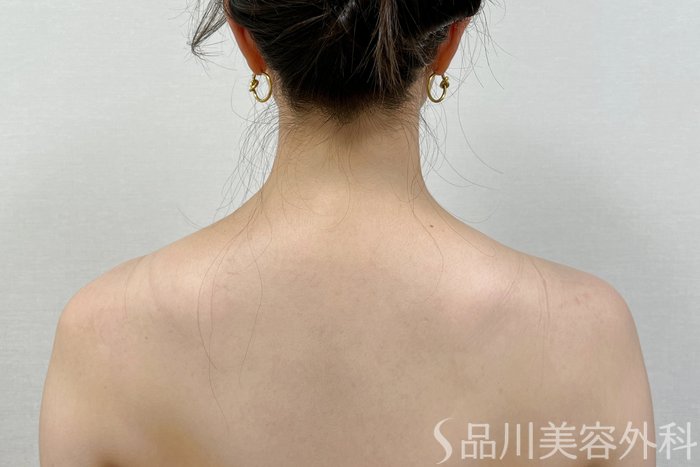 症例NO.73560のAFTER写真