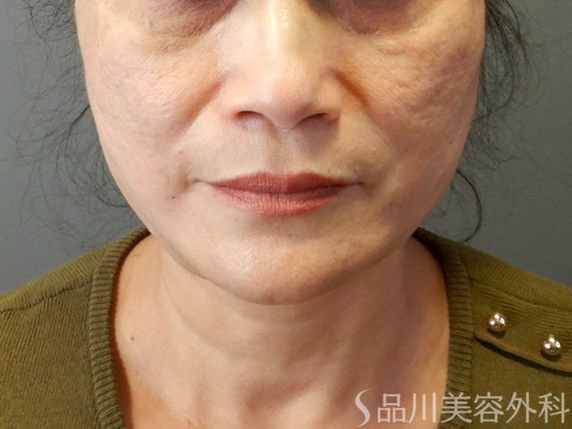 症例NO.65712のAFTER写真