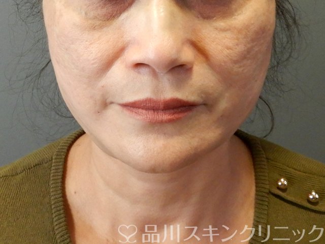 症例NO.65712のAFTER写真