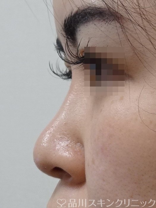 症例NO.70876のBEFORE写真
