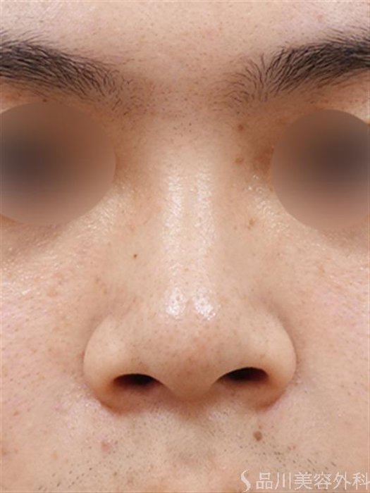 症例NO.50680のBEFORE写真