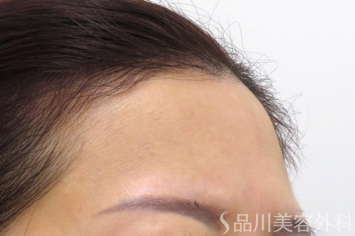 症例NO.75302のBEFORE写真