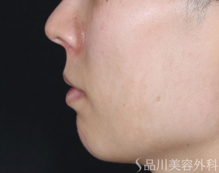 症例NO.72347のBEFORE写真