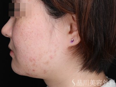 症例NO.74017のBEFORE写真