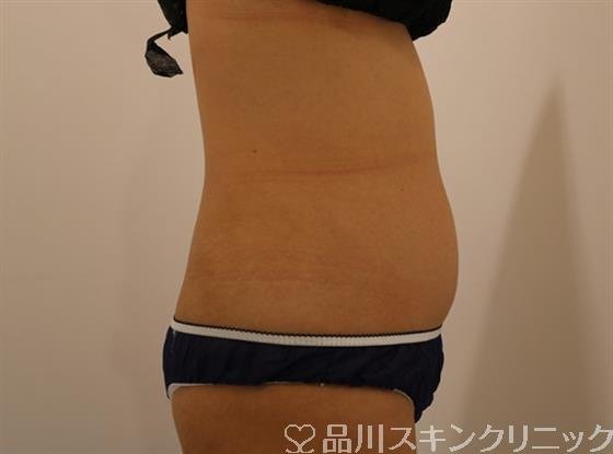 症例NO.44251のBEFORE写真