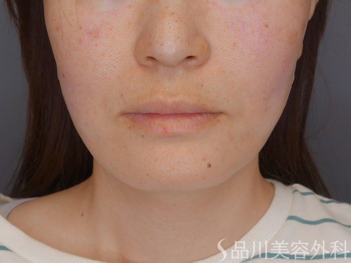 症例NO.72110のAFTER写真