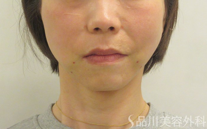 症例NO.70121のAFTER写真
