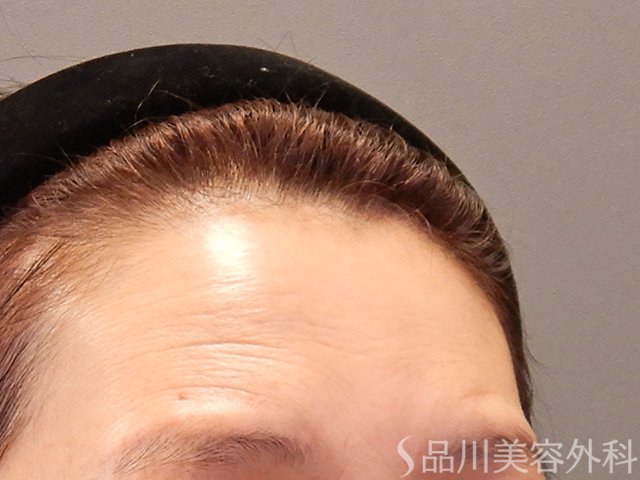 症例NO.73970のBEFORE写真