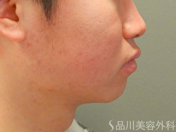 症例NO.69691のAFTER写真
