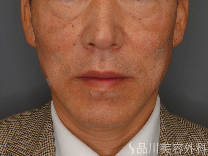 症例NO.75061のAFTER写真