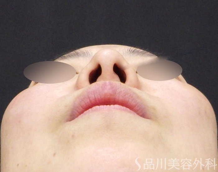 症例NO.72409のBEFORE写真