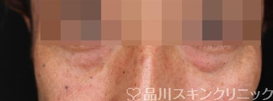 症例NO.52405のBEFORE写真