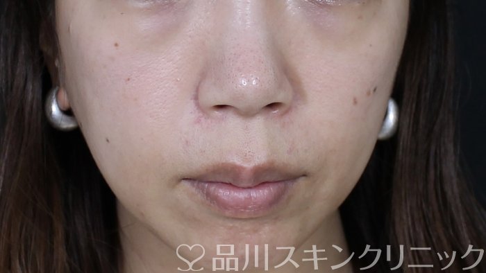 症例NO.71170のBEFORE写真