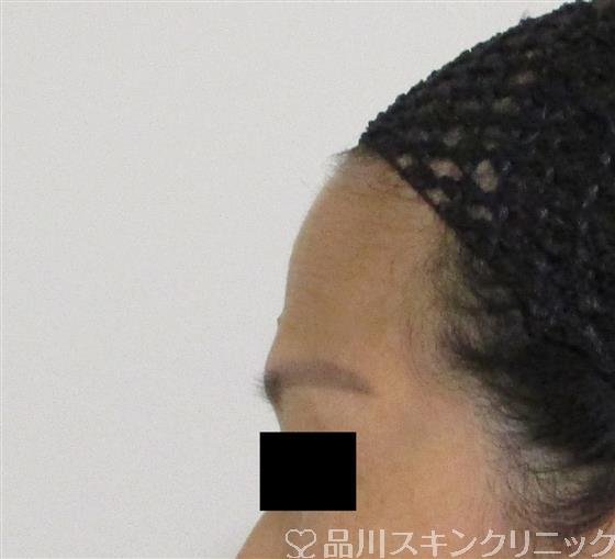 症例NO.59523のBEFORE写真