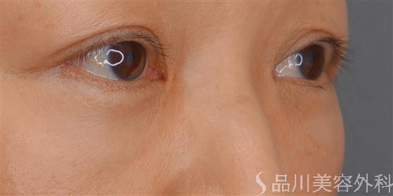 症例NO.61477のAFTER写真