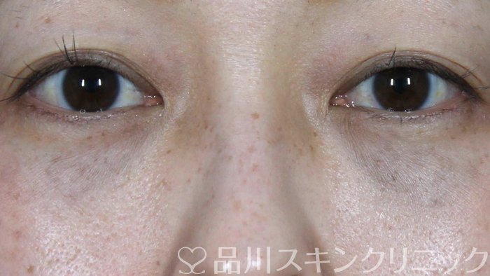 症例NO.71058のAFTER写真
