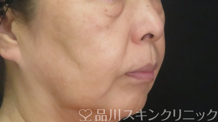 症例NO.71997のBEFORE写真