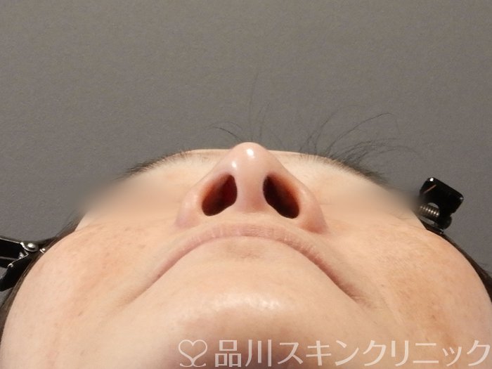 症例NO.63387のBEFORE写真