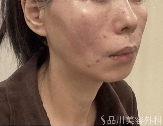 症例NO.75362のAFTER写真