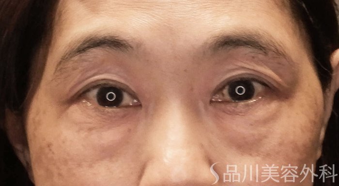 症例NO.65646のBEFORE写真