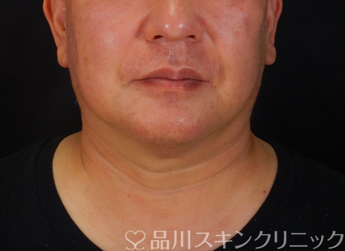 症例NO.65724のAFTER写真