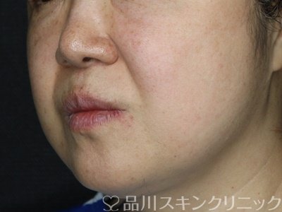 症例NO.74896のBEFORE写真