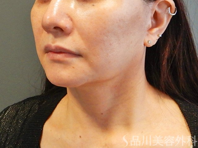 症例NO.65542のAFTER写真
