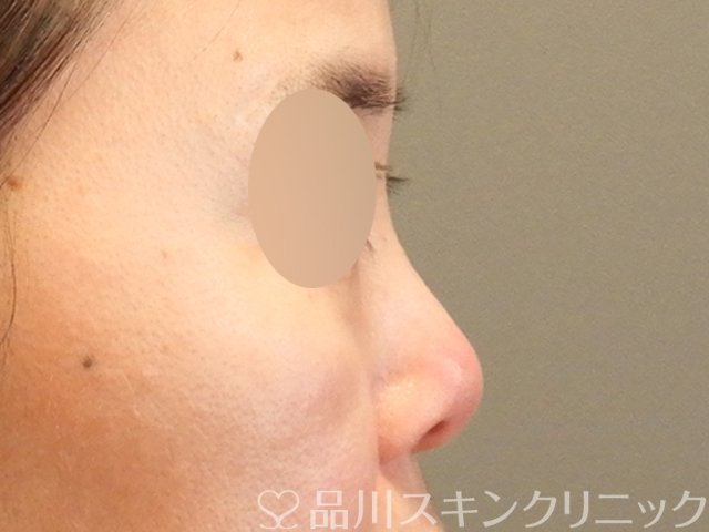 症例NO.66183のBEFORE写真