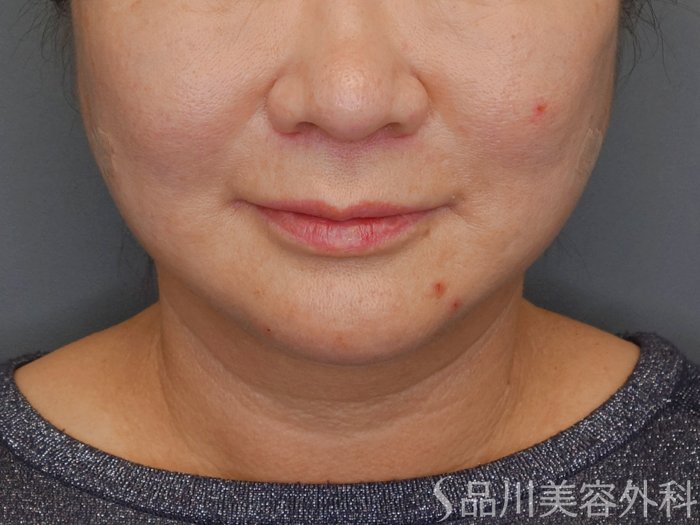 症例NO.72816のAFTER写真