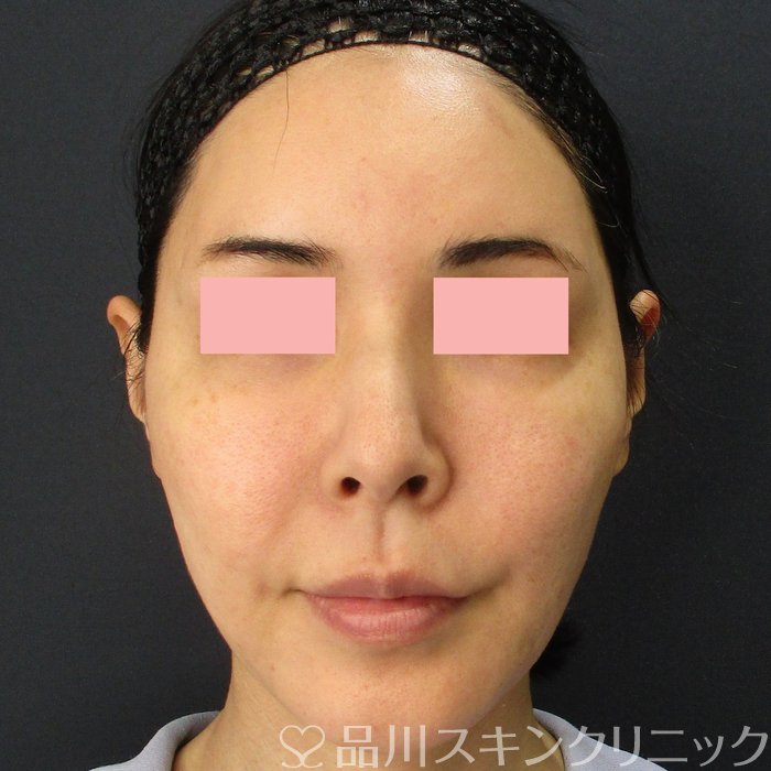 症例NO.71608のBEFORE写真
