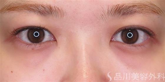 症例NO.47003のBEFORE写真