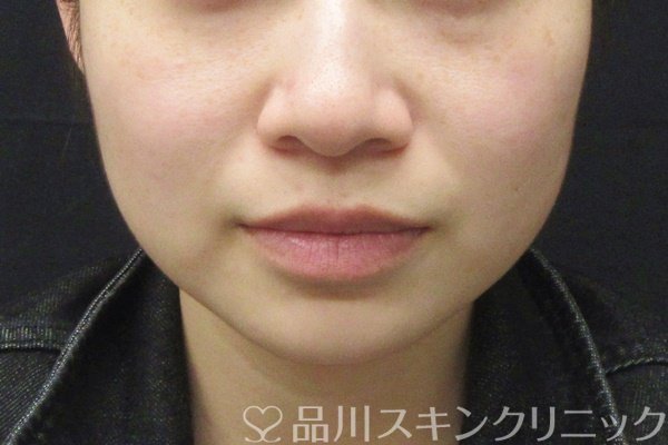 症例NO.65041のBEFORE写真