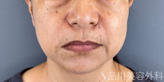 症例NO.71778のAFTER写真