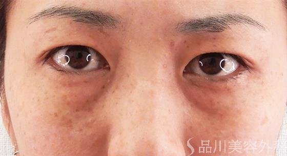 症例NO.59093のBEFORE写真
