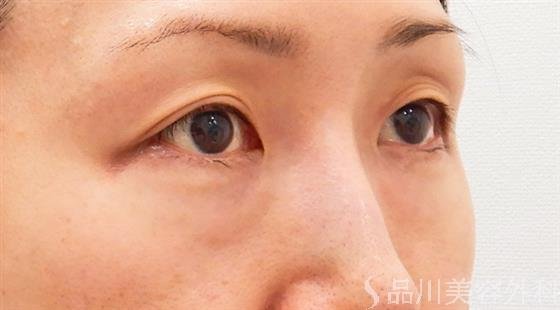 症例NO.60739のBEFORE写真
