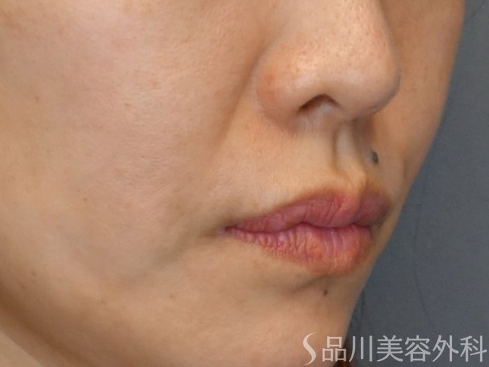 症例NO.72494のBEFORE写真