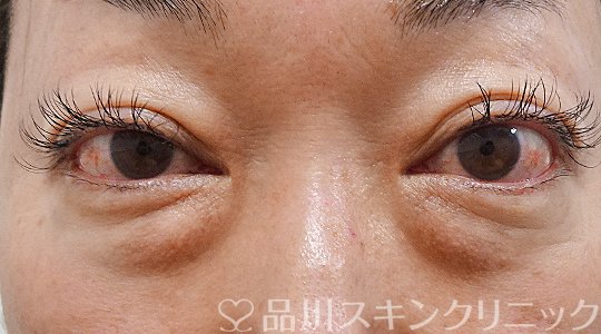 症例NO.62928のBEFORE写真