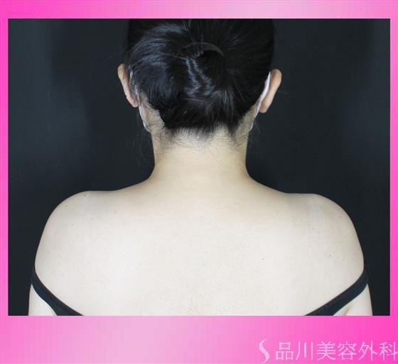 症例NO.56128のAFTER写真