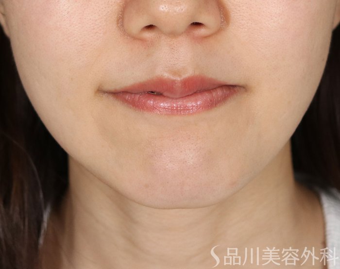 症例NO.74051のBEFORE写真