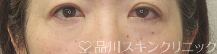 症例NO.72408のAFTER写真