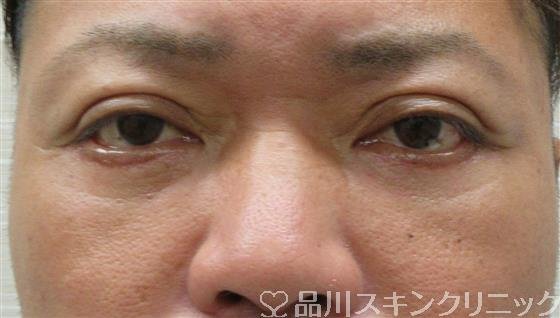 症例NO.57826のAFTER写真