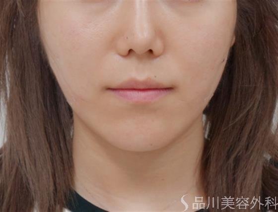 症例NO.36966のAFTER写真
