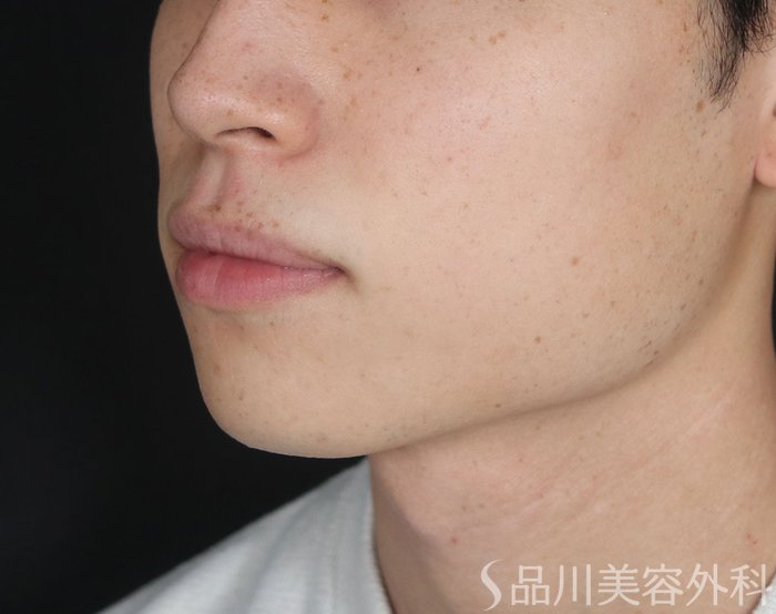 症例NO.73260のBEFORE写真