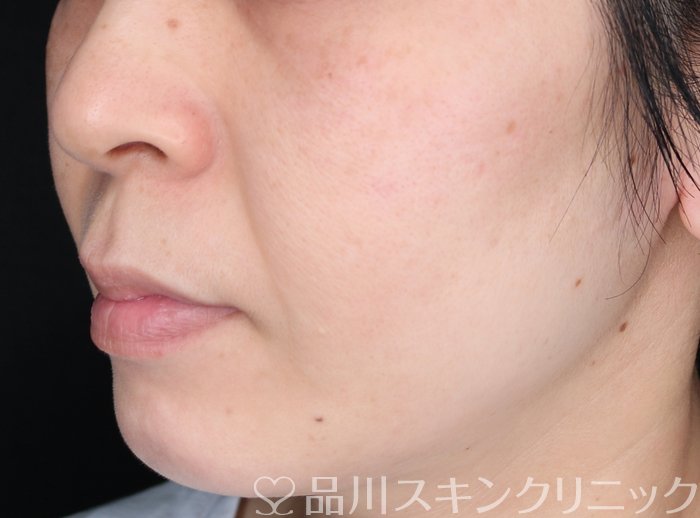 症例NO.64320のAFTER写真