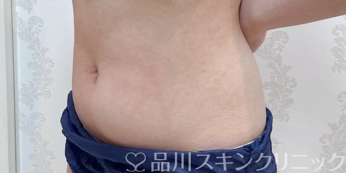 症例NO.69949のBEFORE写真