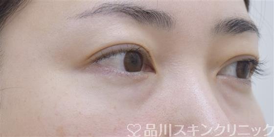 症例NO.52948のBEFORE写真