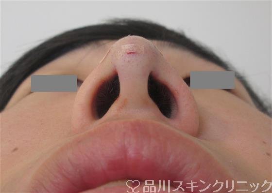 症例NO.32395のAFTER写真