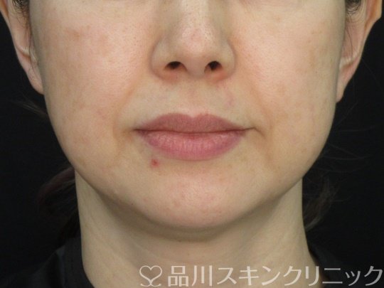 症例NO.72425のBEFORE写真