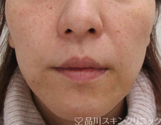 症例NO.41444のAFTER写真