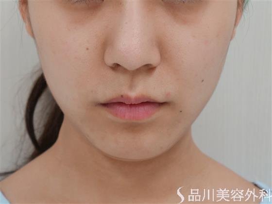 症例NO.41745のBEFORE写真